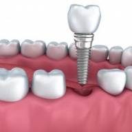 Cuándo es necesario realizar un implante dental